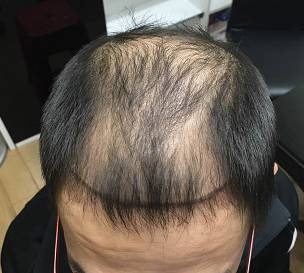 脱发3